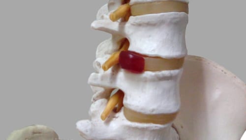 椎間板ヘルニア・脊柱管狭窄症　手術をしても治らなかったらやるべきこと【川口陽海の腰痛改善教室 第20回】